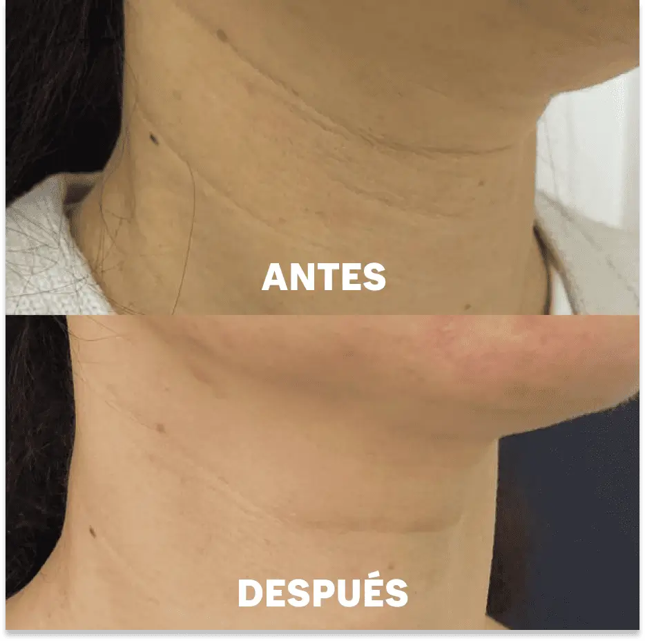 Mascarillas para el Cuello Aurealface™